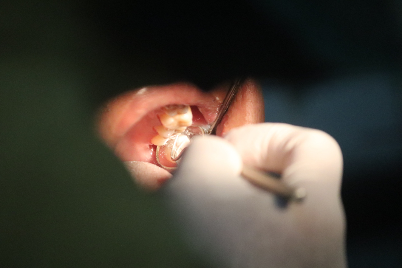 Лечение многоканального зуба