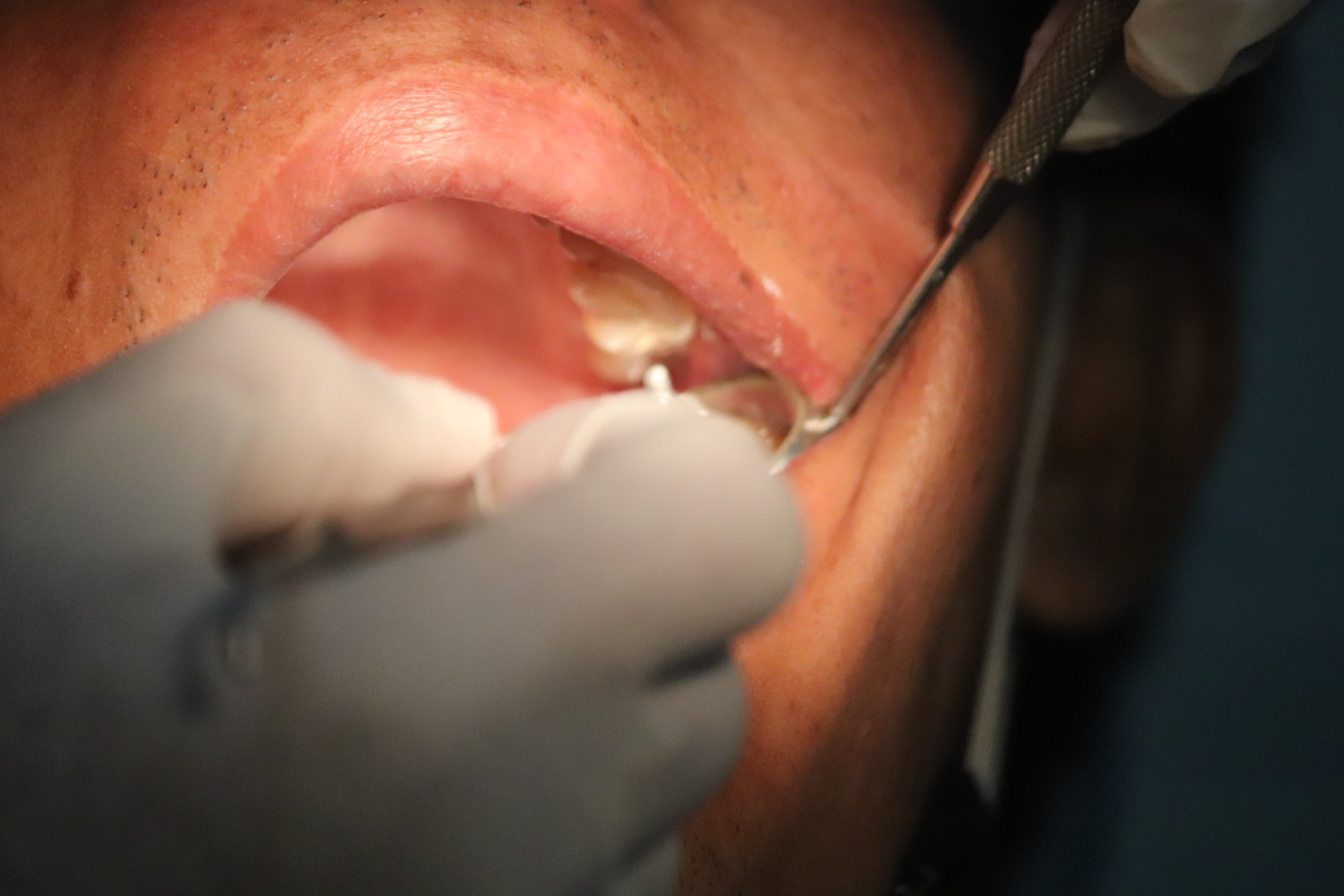 Лечение многоканального зуба
