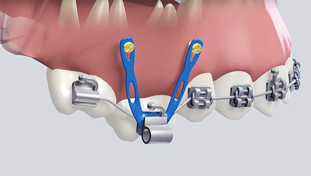 Ортодонтические имплантаты